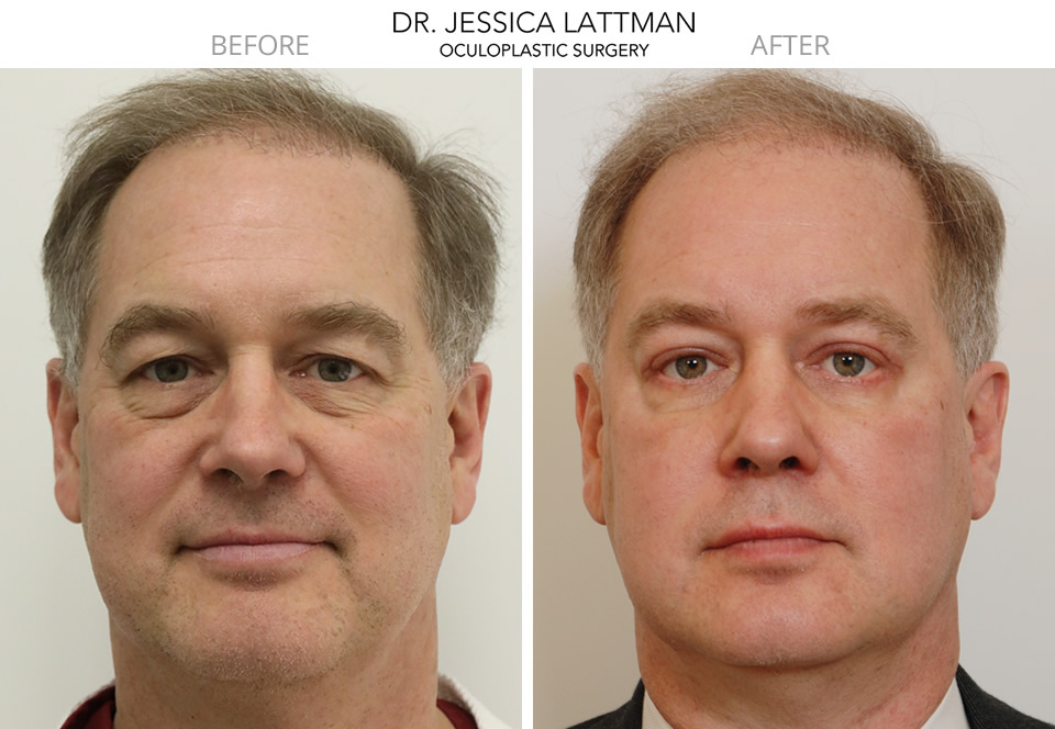 Upper and lower Eyelid Surgery Case Study