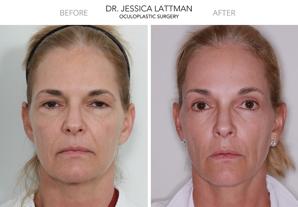 Blepharoplasty and Browlift