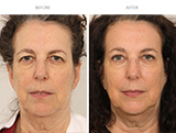 Blepharoplasty 