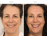 Blepharoplasty 