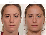 Ptosis Repair