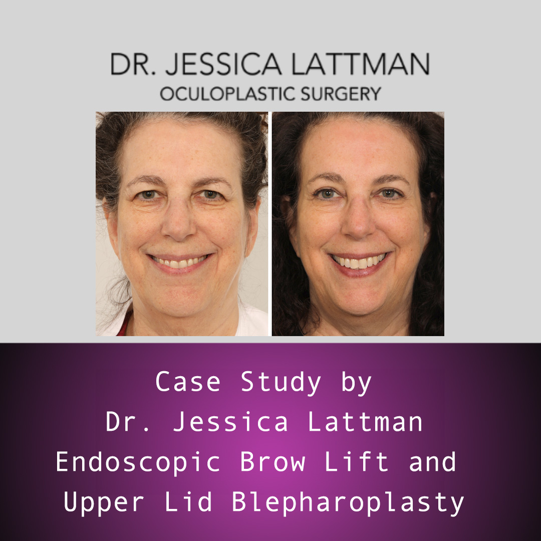 Endoscopic Brow Lift and Upper Lid Blepharoplasty