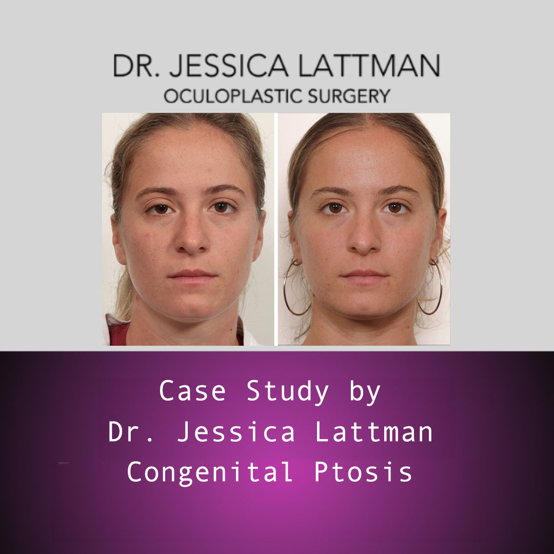 Endoscopic Brow Lift and Upper Lid Blepharoplasty