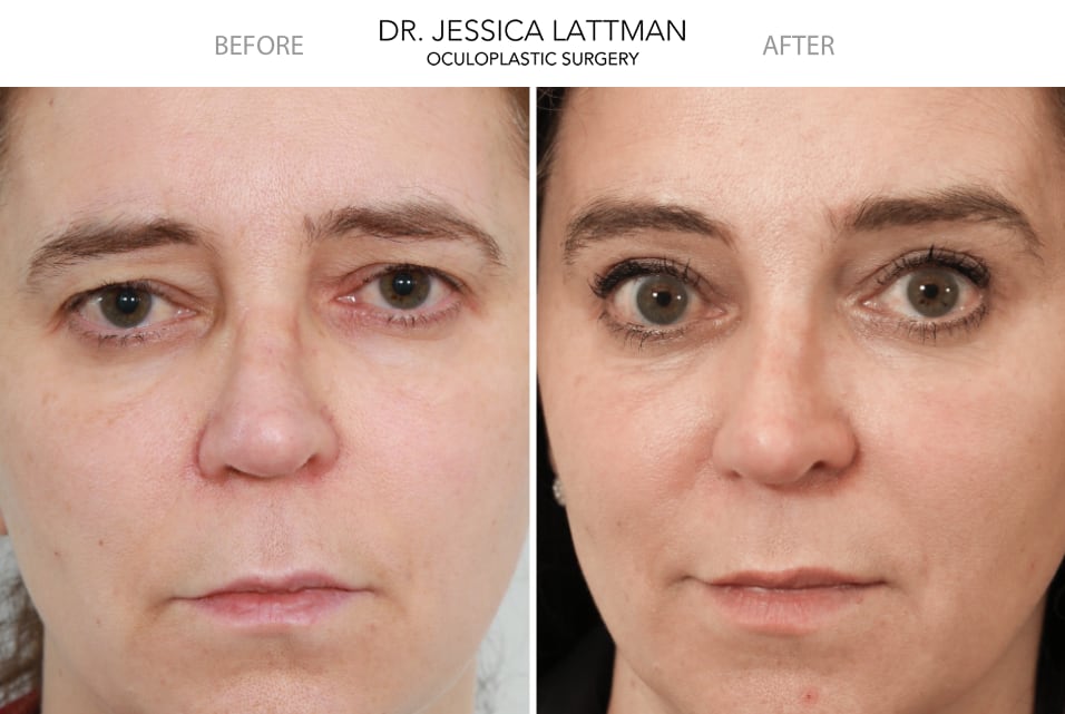 Endoscopic Browlift Expert Nyc Droopy Eyebrows New York And Manhattan Nyc