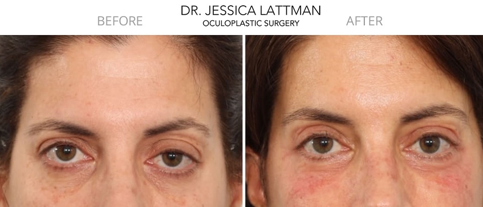Endoscopic Browlift Expert Nyc Droopy Eyebrows New York And Manhattan Nyc