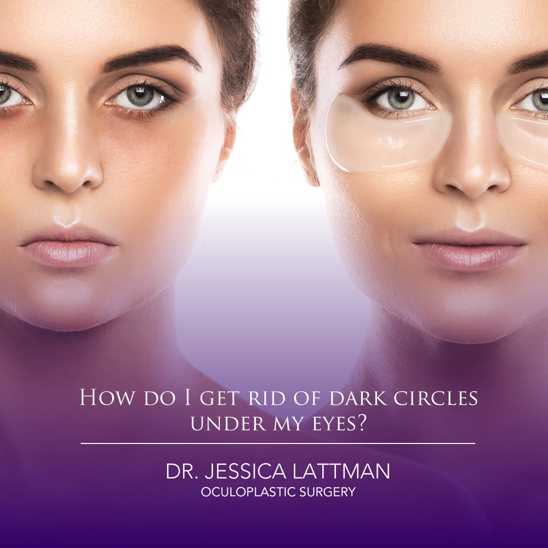 Dark Circles Under Eyes, Causes, Treatment